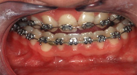 Брекет-система, установленная на зубы верхней и нижней челюсти