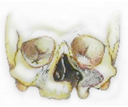 Левосторонняя расщелина верхней губы, альвеолярного отростка и нёба