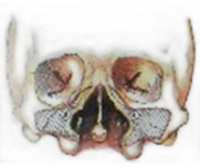 Двусторонняя расщелина верхней губы, альвеолярного отростка и нёба