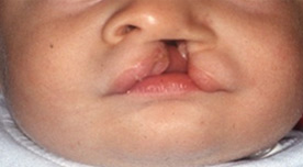 Маленький пациент до операции по поводу расщелины верхней губы (хейлопластика)