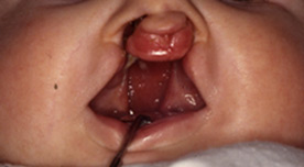 Двусторонняя расщелина верхней губы, альвеолярного отростка и нёба