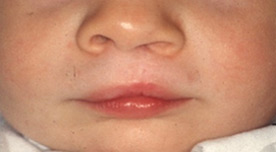 Маленький пациент после операции по поводу расщелины верхней губы (хейлопластика)