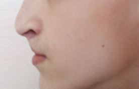 Пациент до коррекционной ринопластики и пластики верхней губы