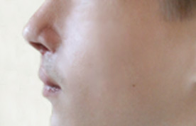 Пациент после коррекционной ринопластики и пластики верхней губы